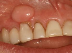 What is a hard lump on my gums without pain?