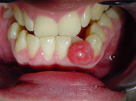 What is a lump or cyst in the mouth?