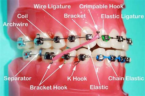 What is a nickname for braces?