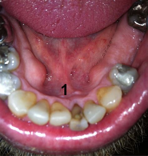 What is a pea sized lump on the floor of my mouth?