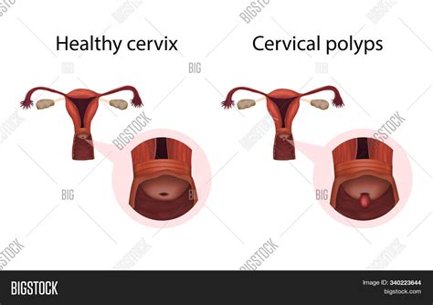What is a polyp sticking out of the cervix?