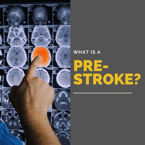 What is a pre stroke?