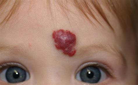 What is a red birthmark called?