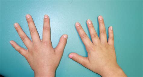 What is a short little finger syndrome?