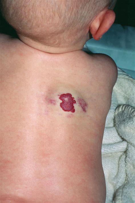 What is a strawberry birth mark?