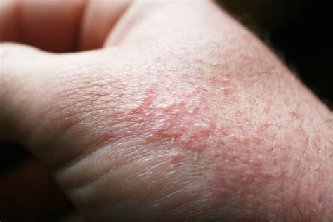 What is a wet rash?