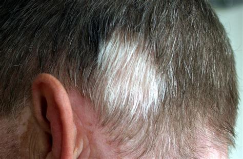 What is a white hair spot called?