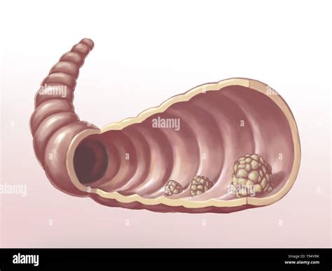 What is an abnormal growth of a polyp?