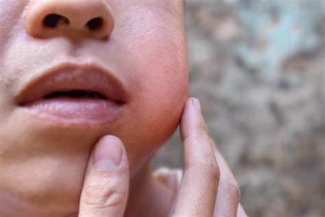 What is an oral lump?