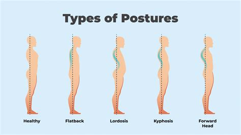 What is bad neck posture called?