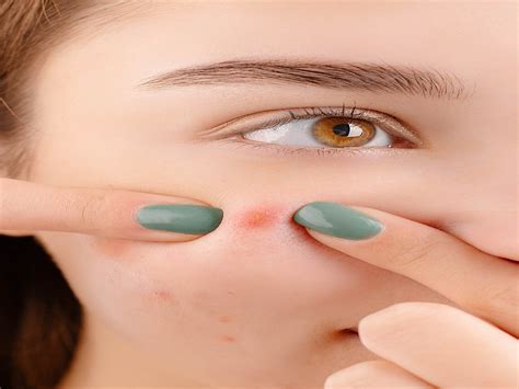 What is blind acne?