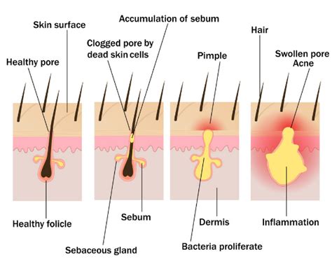 What is blind pimple?