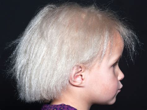 What is blonde hair syndrome?