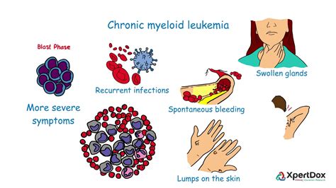 What is borderline leukemia?