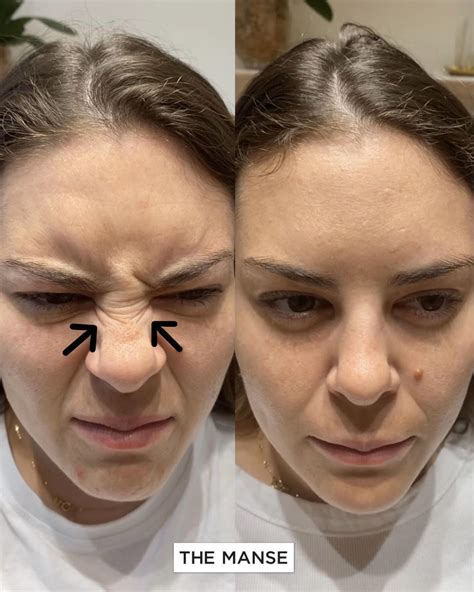 What is bunny nose after Botox?