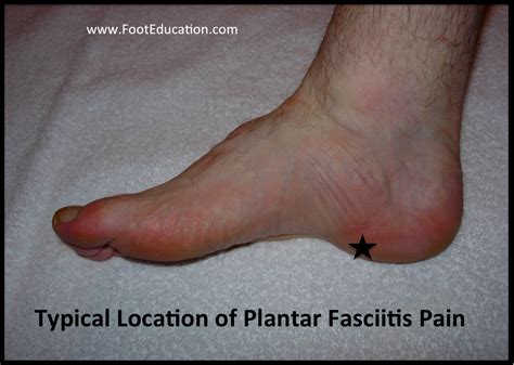 What is commonly mistaken for plantar fasciitis?