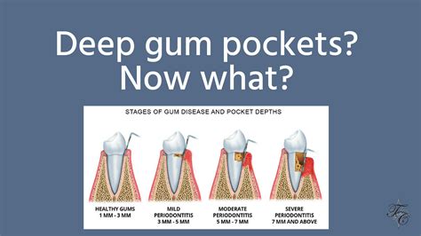 What is considered a deep gum pocket?