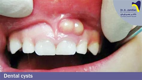 What is dental cyst?
