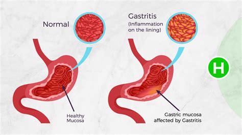 What is gastritis caused by?