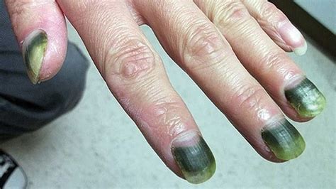 What is green nail syndrome?