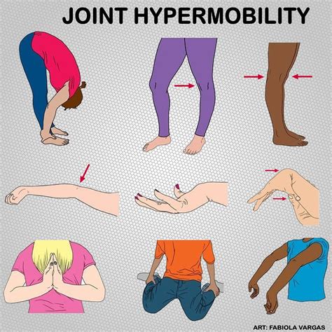 What is hypermobility in 14 month olds?