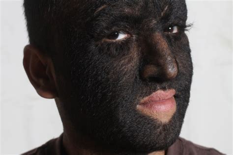 What is hypertrichosis?