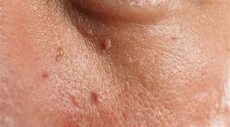 What is inside a skin tag?