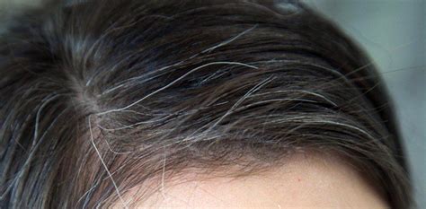 What is it called when you have strands of white hair?
