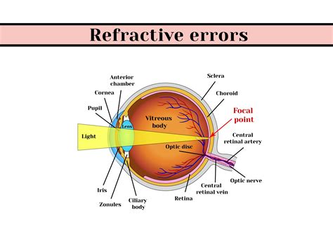 What is lens error?