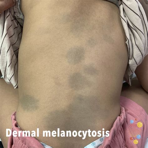 What is melanocytosis?