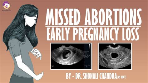 What is missed abortion?