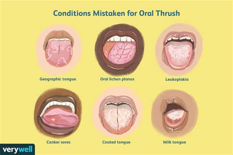 What is mistaken for thrush?