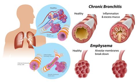 What is mixed COPD?