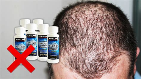 What is powerful than minoxidil?