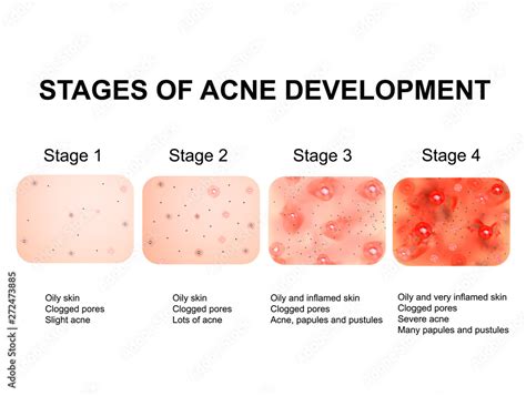 What is stage 3 and 4 active acne?
