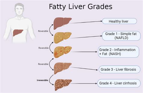 What is stage 4 liver fat?