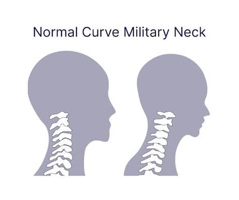 What is straight neck syndrome?