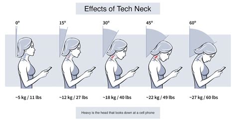 What is tech neck?