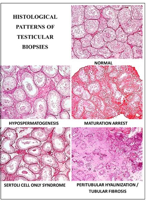 What is testicular biopsy for infertility pathology?