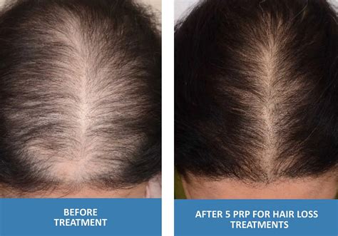 What is the No 1 treatment for hair loss?