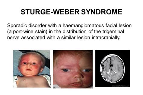 What is the Weber syndrome?