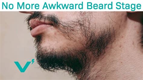 What is the awkward beard stage?
