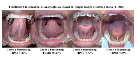 What is the best age for a frenectomy?