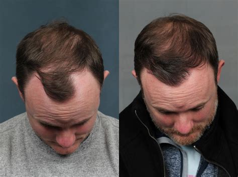 What is the best age for hair transplant?