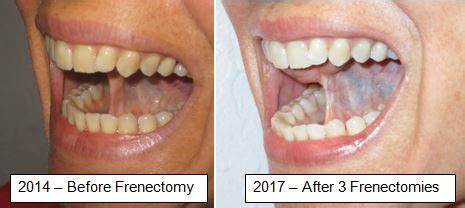 What is the best age to do a frenectomy?