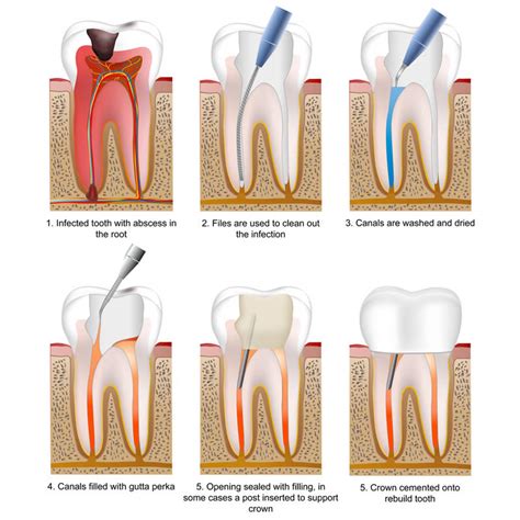 What is the best medicine for a root canal?