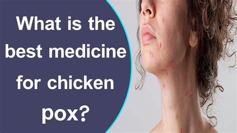 What is the best medicine for fowl pox?