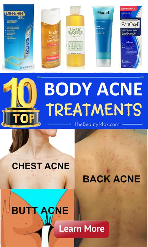 What is the best product for chest acne?