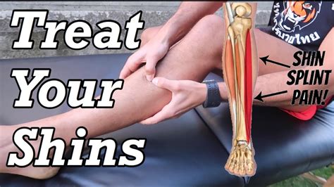 What is the best therapy for shin splints?