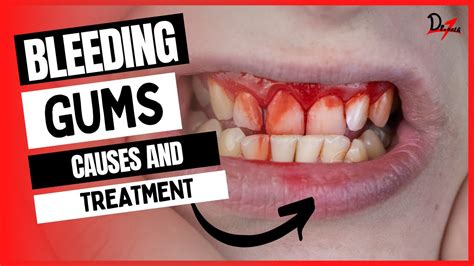 What is the best treatment for bleeding gums?